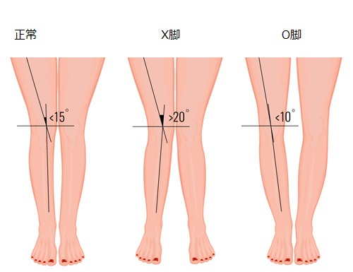 X脚 O脚の治療にピラティスをどう適用しますか ピラティスアメリカ ワークショップ動画 オンライン集客